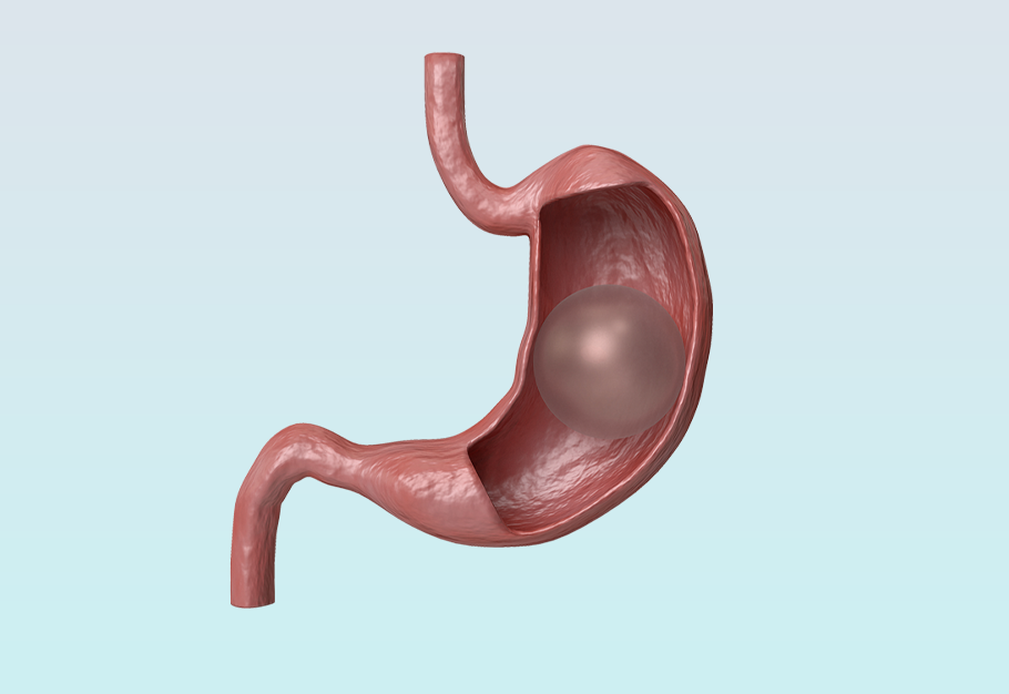 بالون المعدة